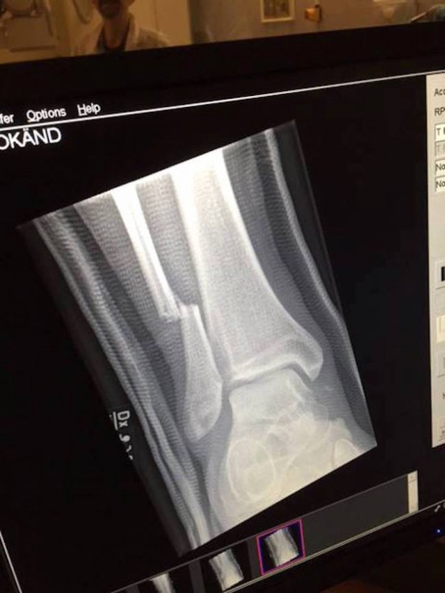 La radiografia della gamba di Dave Grohl dopo la caduta. Fonte: Facebook