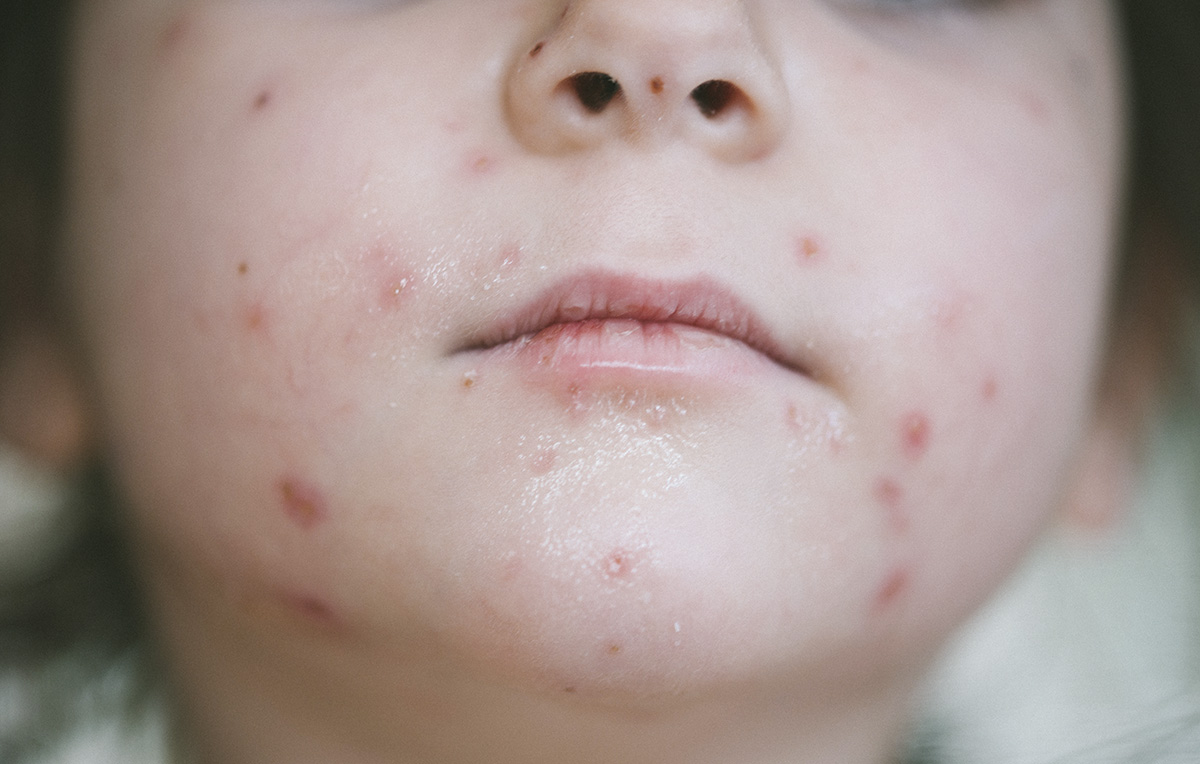 In una scuola no-vax del Nord Carolina è esplosa la peggiore epidemia di varicella degli ultimi 20 anni