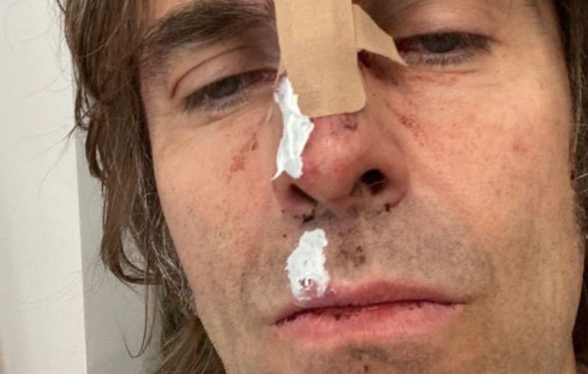 Liam Gallagher ha postato una foto della sua faccia dopo essere «caduto da un elicottero»